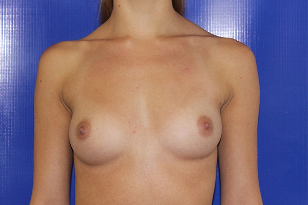 Before Breast Augmentation Female Patient Front Angle View Case 2218