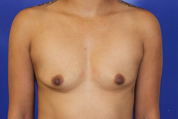 Before Breast Augmentation Female Patient Front Angle View Case 2225