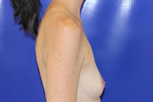 Before Breast Augmentation Female Patient Side Angle View Case 2239