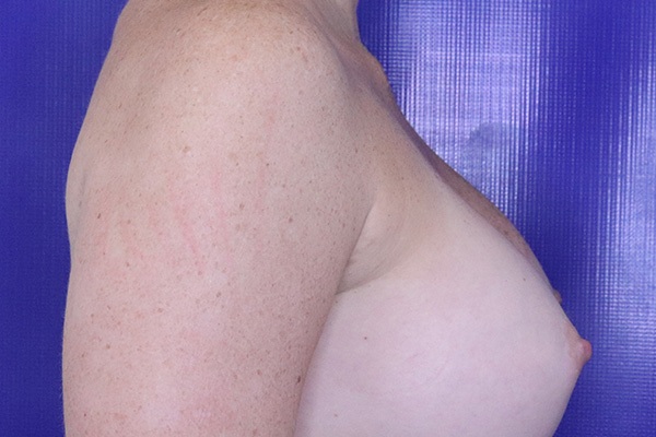 After Breast Augmentation Female Patient Side Angle View Case 2254