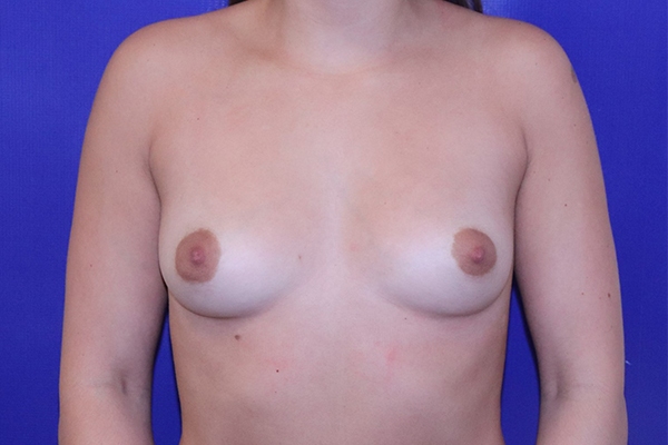 Before Breast Augmentation Female Patient Front Angle View Case 2261