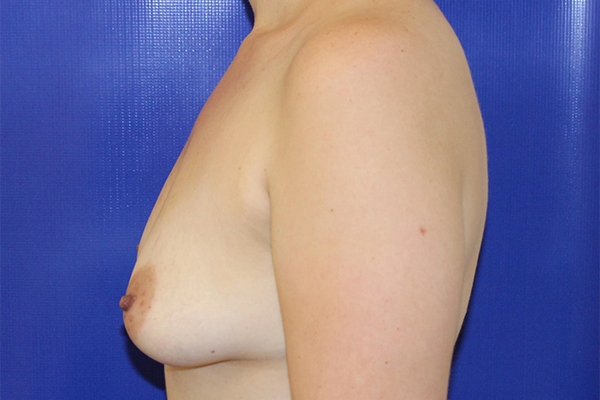 Before Breast Lift Female Patient Side Angle View Case 2296