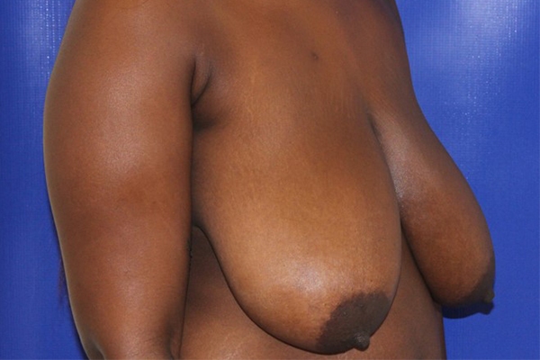 Before Breast Reduction Female Patient Diagonal Angle View Case 2331