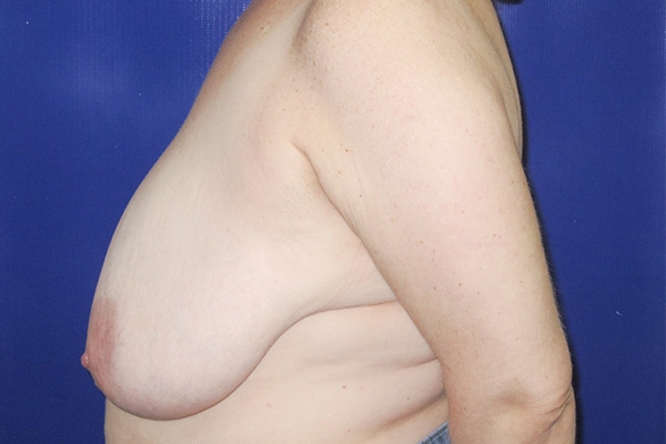 Before Breast Reduction Female Patient Side Angle View Case 2338