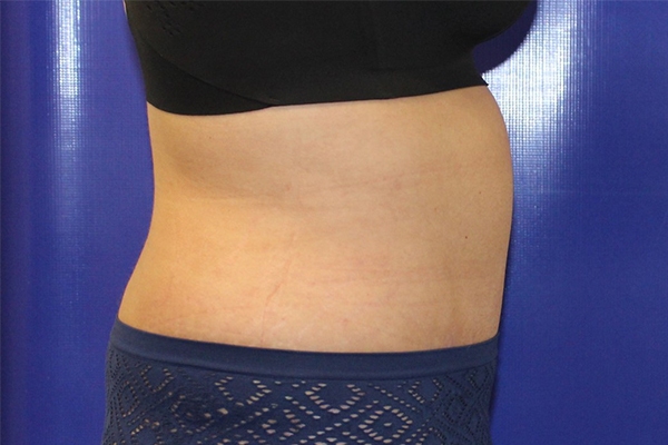 After Circumferential Abdominoplasty Female Patient Side Angle View Case 2381