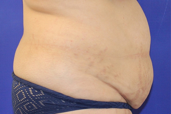 Before Circumferential Abdominoplasty Female Patient Side Angle View Case 2381