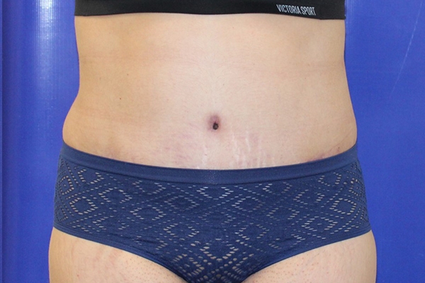After Circumferential Abdominoplasty Female Patient Front Angle View Case 2381