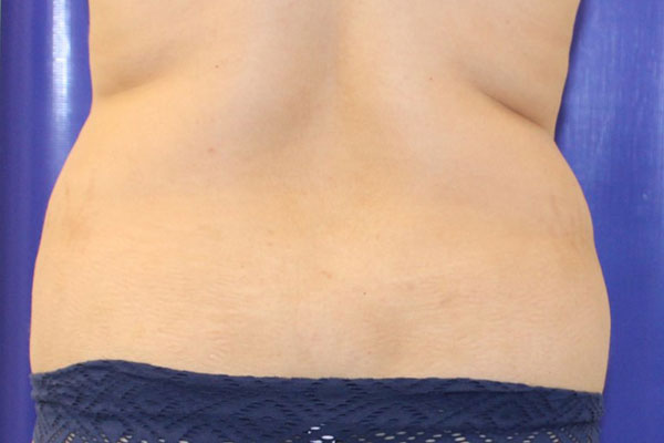 Before Circumferential Abdominoplasty Female Patient Back Angle View Case 2381