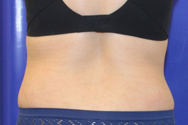 After Circumferential Abdominoplasty Female Patient Back Angle View Case 2381