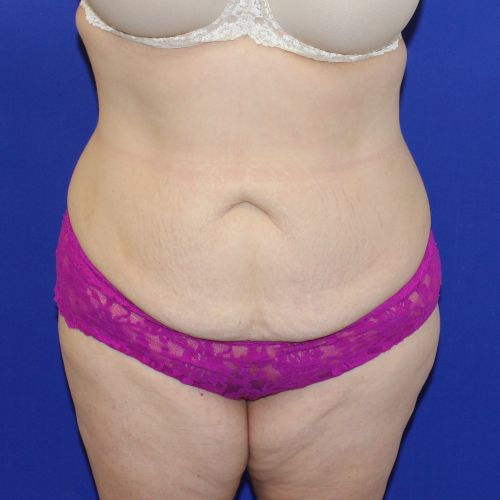 before halo lift female patient front view case 2464