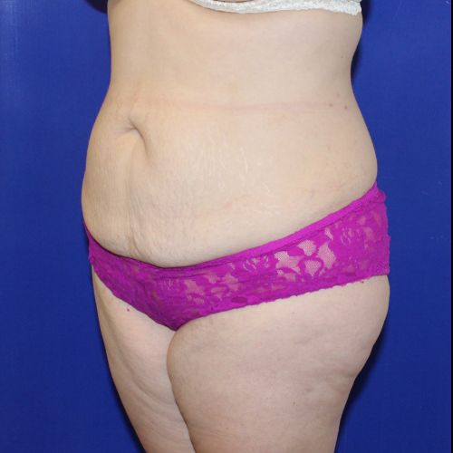 before halo lift female patient front angle view case 2464