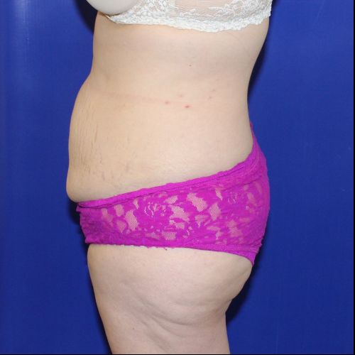 before halo lift female patient side view case 2464