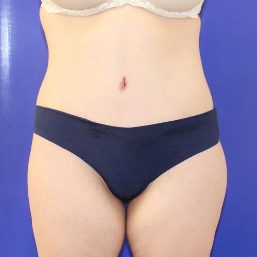 after halo lift female patient front view case 2464