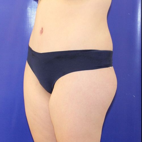 after halo lift female patient front angle view case 2464