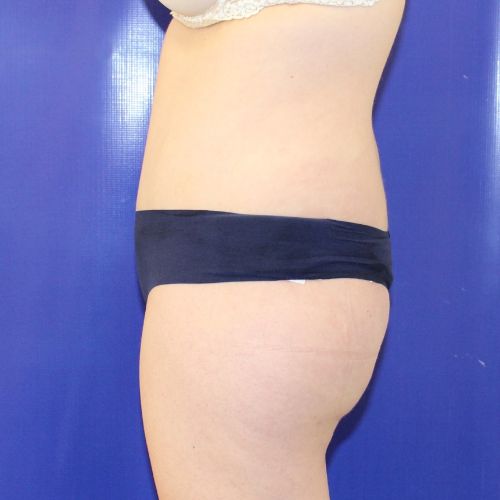 after halo lift female patient side view case 2464