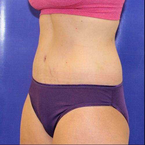 after halo lift female patient front angle view case 2473