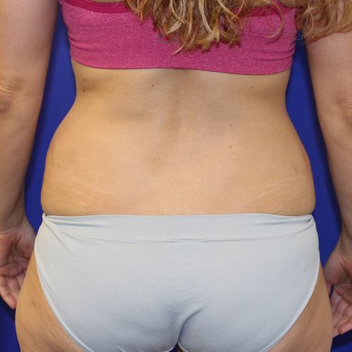 before halo lift female patient back view case 2473