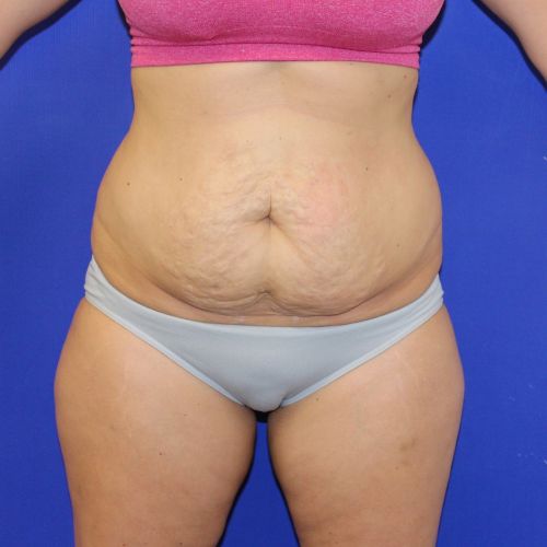 before halo lift female patient front view case 24732