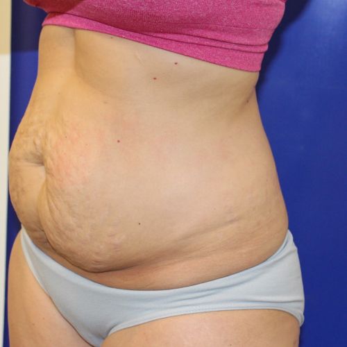 before halo lift female patient front angle view case 5473