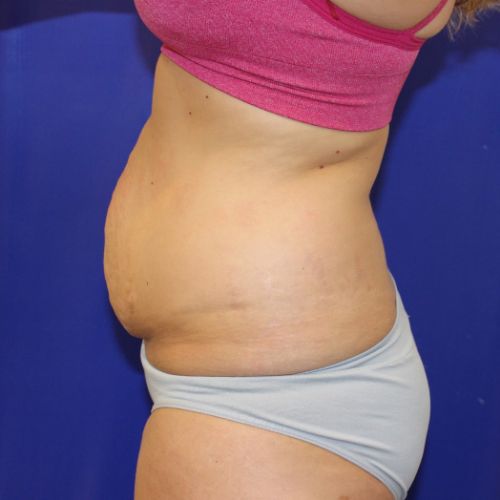 before halo lift female patient side view case 2473