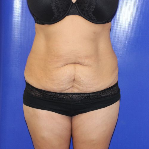 before halo lift female patient front view case 2482