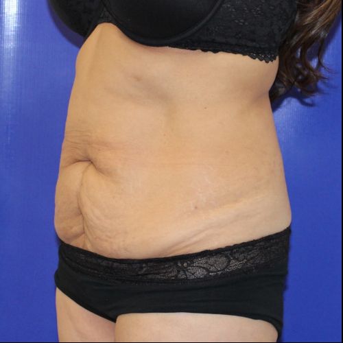 before halo lift female patient front angle view case 2482