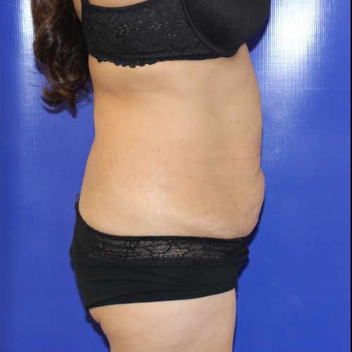 before halo lift female patient side view case 2482