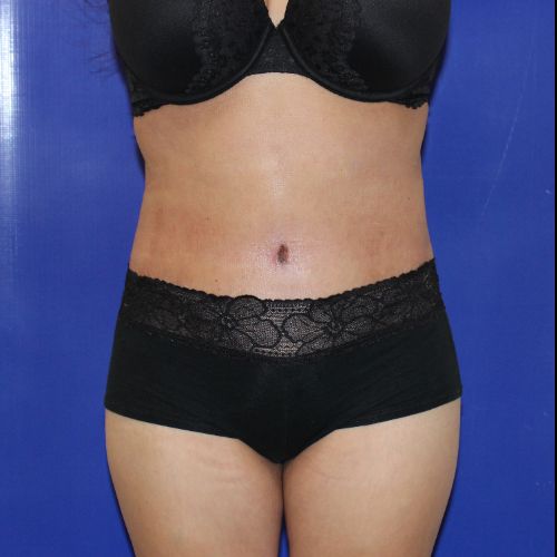 after halo lift female patient front view case 2482