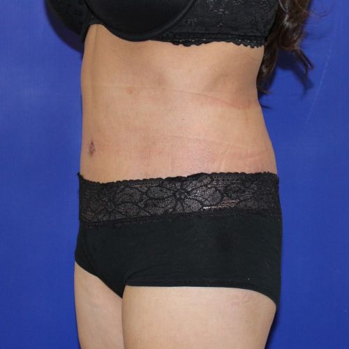 after halo lift female patient front angle view case 2482