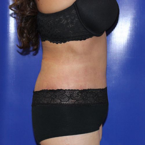 after halo lift female patient side view case 2482