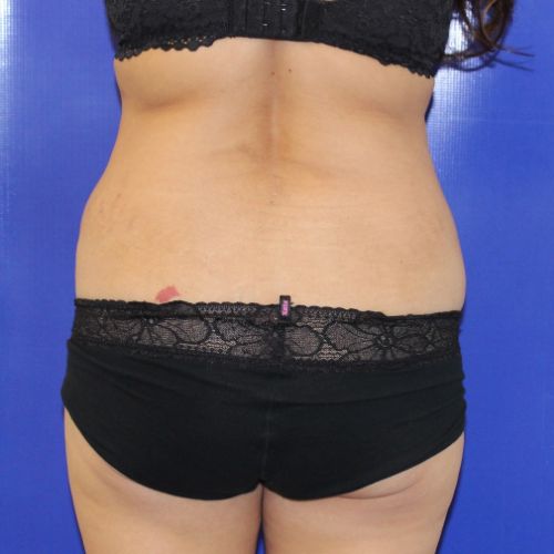 before halo lift female patient back view case 2482