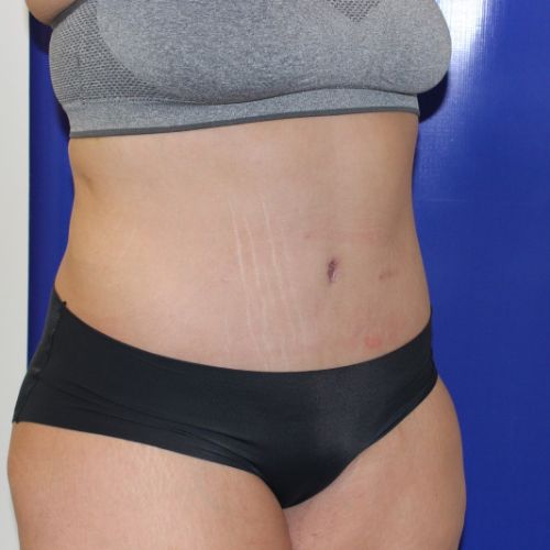 after halo lift female patient front angle view case 2500