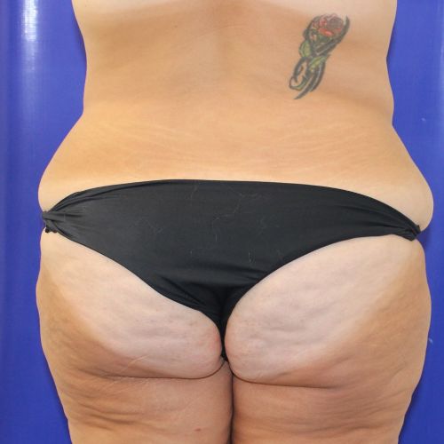 before halo lift female patient back view case 2500