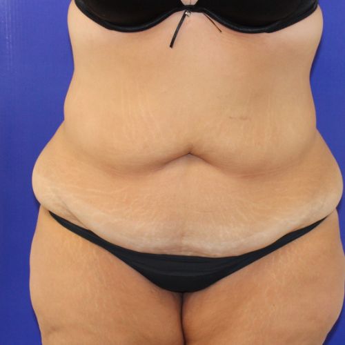 before halo lift female patient front view case 2500