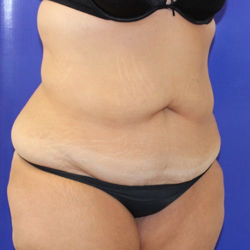 before halo lift female patient front angle view case 2500