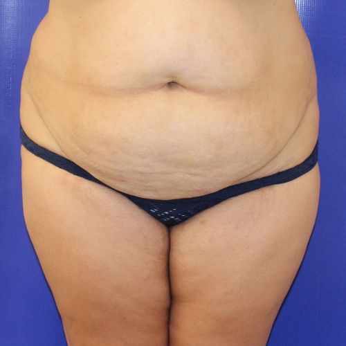 before halo lift female patient front view case 2509