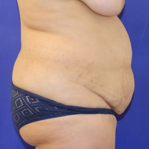 before halo lift female patient side view case 2509