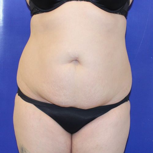 before halo lift female patient front view case 2518