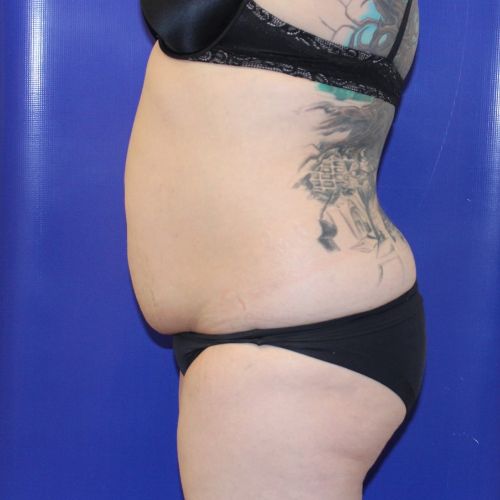 before halo lift female patient side view case 2518