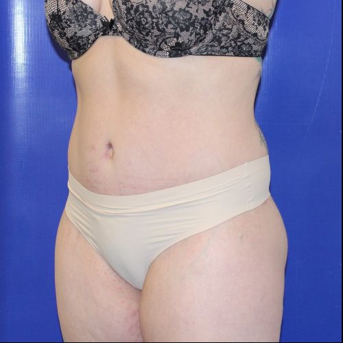 after halo lift female patient front angle view case 2518