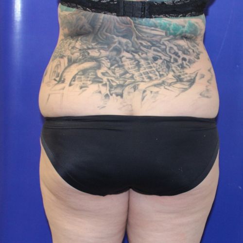 before halo lift female patient back view case 2518