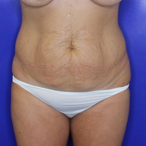 before halo lift female patient front view case 2527