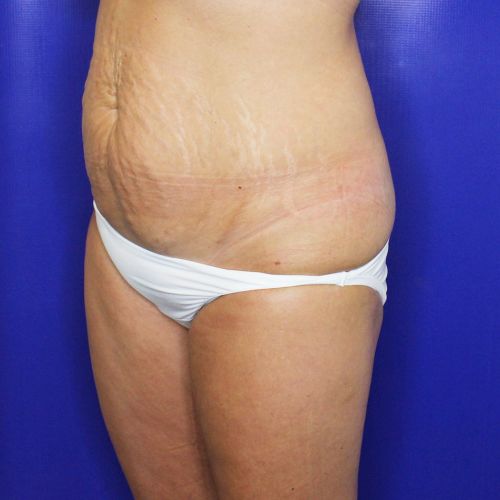 before halo lift female patient front angle view case 2527