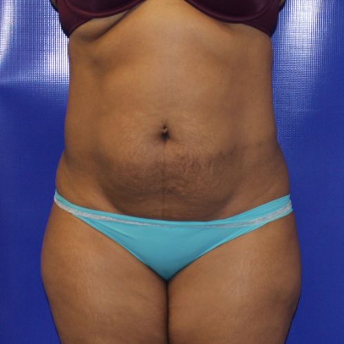 before halo lift female patient front view case 2536