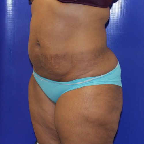 Before Halo Lift Female Patient Diagonal Angle View Case 2536