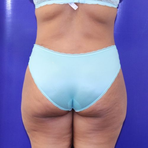 after halo lift female patient back view case 2536