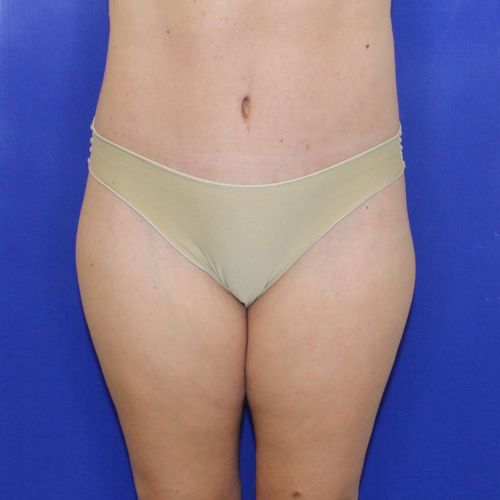 after halo lift female patient front view case 2545