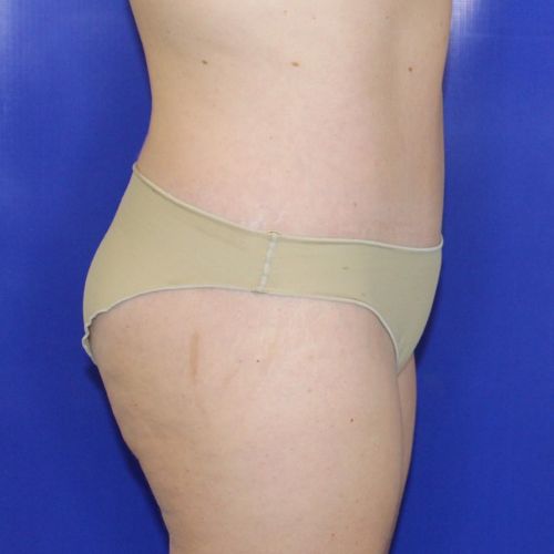 after halo lift female patient side view case 2545