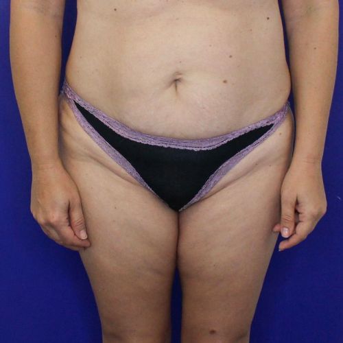 before halo lift female patient front view case 2545