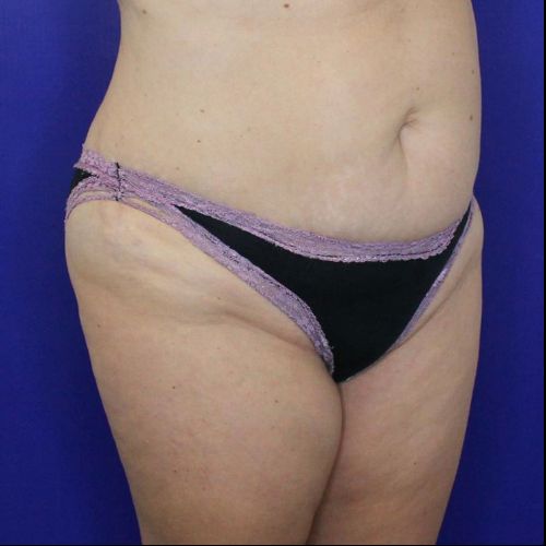 before halo lift female patient front angle view case 2545